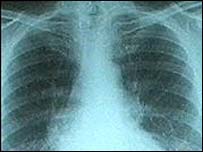 A lung X-ray