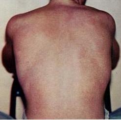 A dengue-lázra jellemző kiütések a beteg hátán