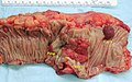 Carcinoma invasivo del colon (al centro). Ai lati è possibile identificare formazioni polipoidi