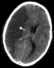 CT scan sisi kiri utak nan maalami kakurangan darah (gejala stroke iskemik) dari sumbatan pado arteri.