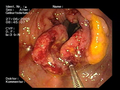 Biopsia in corso di colonscopia di massa tumorale vegetante il colon ascendente