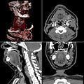 TC cranial; dalt a l'esquerra: representació 3D; dalt a la dreta: tall axial, a sota a l'esquerra: tall sagital, baix a la dreta: tall frontal