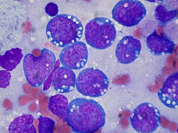Burkitt-limfóma citológiai megjelenése (Wright-festés). Nagy, daganatos limfociták láthatóak, melyek citoplazmájában vakuólumok figyelhetők meg.