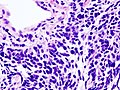 Immagine istologica E2 Carcinoma polmonare a piccole cellule: ulteriore immagine istologica.