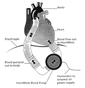 Esquema de funcionamento de um coração artificial