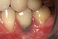 La recessione della gengiva porta all'esposizione dell'abutment metallico sotto una corona dentale.