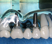 Un ponte di denti può essere supportato da due o più impianti.