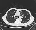 Metasztatikus carcinoma CT felvétele