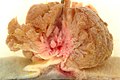 Adenoma villoso del colon-sigma