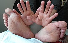 Ruam-ruam pado tangan jo kaki laki-laki baumua 36 tahun