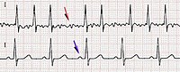 Fibrillazione atriale: è una patologia elettrica degli atri, che presenta una caratteristica costante: l'attivazione elettrica rapida e apparentemente caotica del tessuto atriale. Il tracciato superiore mostra le fini onde della fibrillazione (freccia rossa) e assenza dell'onda P, in contrapposizione all'isoelettrica "pulita" del ritmo sinusale nel secondo tracciato, che evidenzia la presenza dell'onda P (freccia blu).[54]