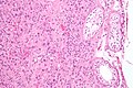 Micrograph of a Leydig cell tumour