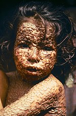 Thumbnail for File:Child with Smallpox Bangladesh.jpg