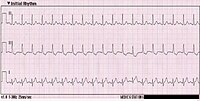 Tachicardia sinusale: si ha con l'innalzamento della frequenza cardiaca al di sopra di 100 battiti al minuto
