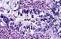 Immagine istologica B Adenocarcinoma a cellule chiare: le strutture cellulari si organizzano formando aggregati pseudo-ghiandolari. Le cellule appaiono chiare per la notevole presenza di muco.