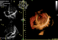 4. GIF-animáció, amelyen egy szívultrahang mozgóképe (echokardiogramja) látható; térhatású ismétlődő felvétel a szívcsúcs felőli nézetben, elhagyva a kamrák csúcshoz tartozó részét, de láthatóvá téve a mitrális szívbillentyűt. Az adatok hiánya miatt a trikuszpidális és az aortabillentyű nem látszik jól, de a nyílásuk igen. Balra két kétdimenziós ábra szerepel a 3D-s adathalmazból kiemelve (a fenti képen a trikuszpidális és a mitrális billentyűk, az alsón az aorta- és a mitrális billentyűk ismerhetők fel). (javítás)/(csere)