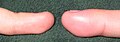 השוואה בין אצבע בצקתית לבין אחת פחות באותה יד - אצבע ימין ואצבע שמאל