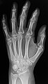Radiografia normale del polso e della mano.