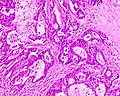 Adenocarcinoma del colon, colorazione con ematossilina-eosina