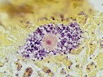 Thumbnail for File:Gram stain of a macrophage with ingested S epidermidis bacteria.jpg