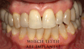 Denti individuali sono stati sostituiti con impianti. Risulta difficile distinguere i veri denti dai denti protesici.