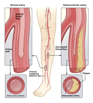 Illustration of atherosclerosis causing arterial obstruction which clinically presents at peripheral artery disease.