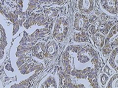 Immunohistochemistry of breast cancer (Infiltrating ductal carcinoma of the breast) assayed with anti HER-2 (ErbB2) antibody.