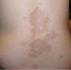 Lokalizált szklerodermás foltok (morfea) egy 16 éves lány hátán.