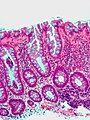 Sezione istologica di polipo iperplastico del colon (lesione benigna)