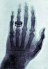 X-ray by Wilhelm Röntgen of Albert von Kölliker's hand - 18960123-01.jpg