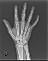 X-ray image of right hand with thumb on left.