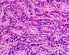 Adenocarcinoma low differentiated (stomach) H&E magn 400x.jpg