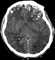 CT snímek znázorňující pohmoždění mozku