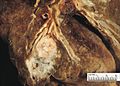 Immagine A3 Carcinoma squamocellulare: formazione nodulare grigiastra che comprime un bronco di grosso calibro. A valle, è presente un'area di addensamento (zona bianca, cotonosa) che testimonia la presenza di un processo di polmonite ostruttiva.