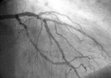 Angiogramma tramite radiografia con mezzo di contrasto radio-opaco iodato delle arterie coronarie del lato sinistro del cuore.