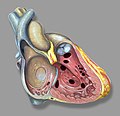 Heart anatomic view of right ventricle and right atrium with example ventricular septal defects