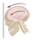 Acceleration (g-kræfter) kan skabe rotationskræfter i hjernen, specielt i midthjernen og diencephalon, og derved forårsage hjernerystelse.