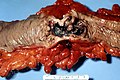Adenocarcinoma ulcerato del colon