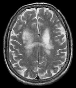 تصوير بالرنين المغناطيسي يوضح الإصابة باعتلال بيضاء الدماغ متعدد البؤر المترقي