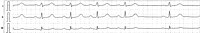 Aritmia sinusale: aumento fasico della frequenza cardiaca in ispirazione (per aumentato ritorno venoso) e rallentamento in espirazione (effetto vagale)