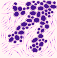 Rappresentazione E Carcinoma polmonare a piccole cellule: si può notare la scarsità del citoplasma e la presenza di nucleo intensamente cromofili. Le cellule si organizzano formando strutture compatte, dall'aspetto a palizzata.