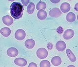 Giant platelets in a person with immune thrombocytopenia pupura. (Blood film Giemsa stain)