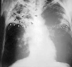 צילום רנטגן של ריאות נגועות בשחפת (מסומן בחצים)