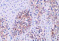 The germ cell markers OCT 3/4 and CD117 (positive immunohistochemistry pictured) are useful for diagnosis.[10]