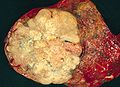 Immagine B Adenocarcinoma polmonare: grande massa periferica, lobulata e dall'aspetto traslucido.