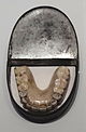 Gebissprothese mit Waterloo-Zähnen
