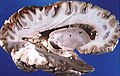 Cervello umano con una dissezione destra, vista laterale.