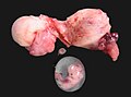 Rupturierte cornuale Eileiterschwangerschaft (OP-Präparat)