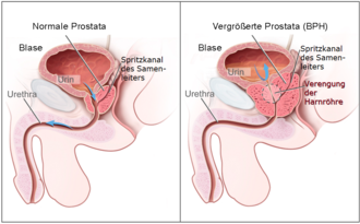Schaubild, das normale und vergrößerte Prostata im Vergleich zeigt