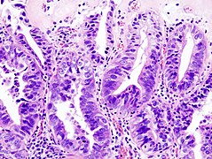 Histopatologia de um adenocarcinoma da vesícula